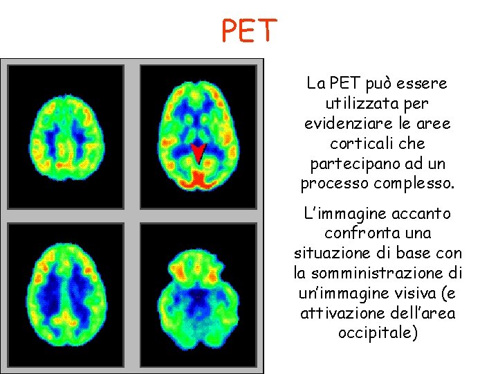 PET La PET può essere utilizzata per evidenziare le aree corticali che partecipano ad