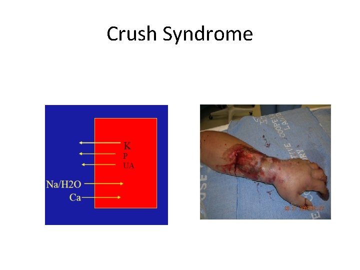 Crush Syndrome 