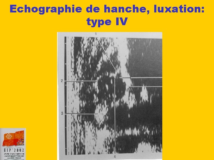 Echographie de hanche, luxation: type IV 