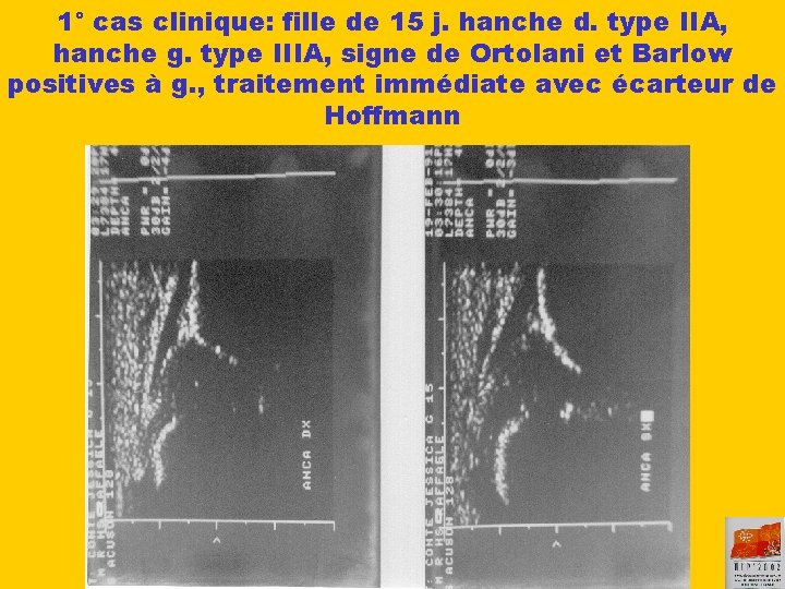 1° cas clinique: fille de 15 j. hanche d. type IIA, hanche g. type