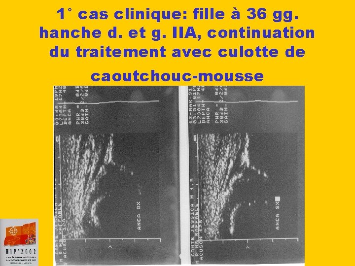 1° cas clinique: fille à 36 gg. hanche d. et g. IIA, continuation du