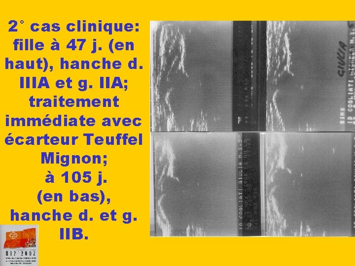 2° cas clinique: fille à 47 j. (en haut), hanche d. IIIA et g.