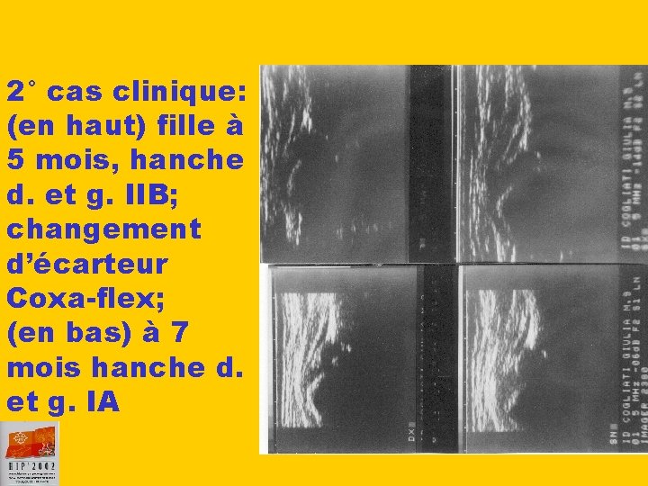 2° cas clinique: (en haut) fille à 5 mois, hanche d. et g. IIB;