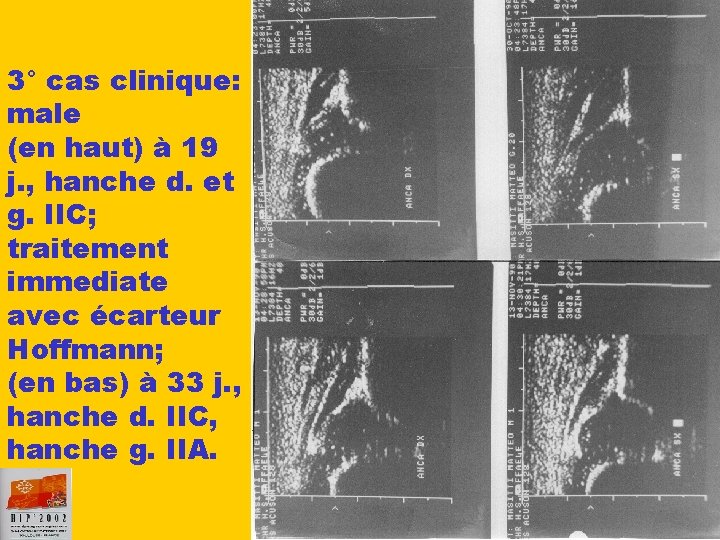 3° cas clinique: male (en haut) à 19 j. , hanche d. et g.