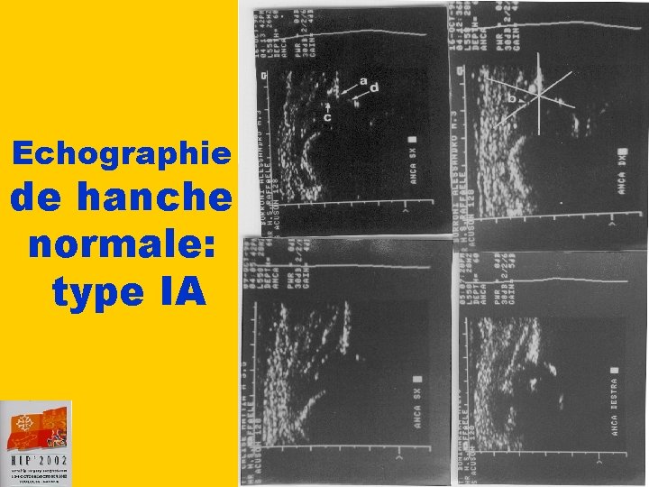 Echographie de hanche normale: type IA 