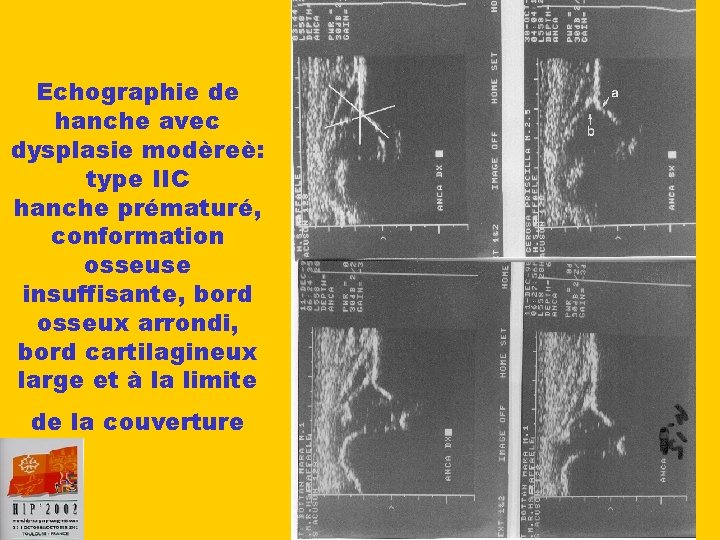 Echographie de hanche avec dysplasie modèreè: type IIC hanche prématuré, conformation osseuse insuffisante, bord