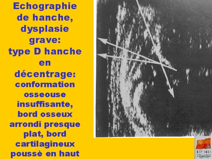 Echographie de hanche, dysplasie grave: type D hanche en décentrage: conformation osseouse insuffisante, bord