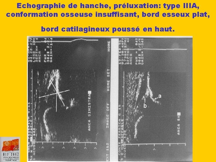 Echographie de hanche, préluxation: type IIIA, conformation osseuse insuffisant, bord esseux plat, bord catilagineux