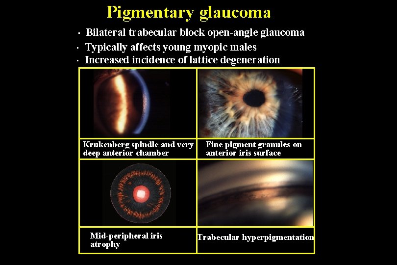 Pigmentary glaucoma • • • Bilateral trabecular block open-angle glaucoma Typically affects young myopic