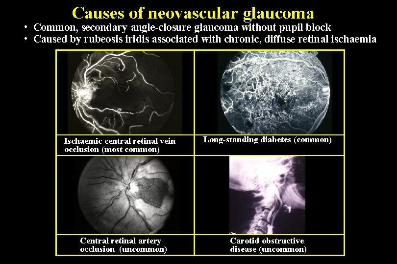 Causes of neovascular glaucoma • Common, secondary angle-closure glaucoma without pupil block • Caused