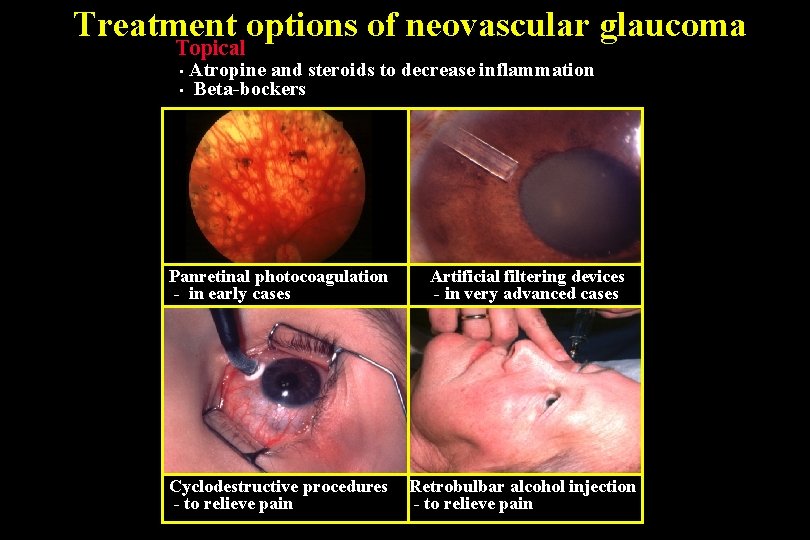 Treatment options of neovascular glaucoma Topical Atropine and steroids to decrease inflammation • Beta-bockers