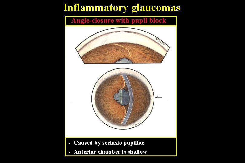 Inflammatory glaucomas Angle-closure with pupil block • Caused by seclusio pupillae • Anterior chamber