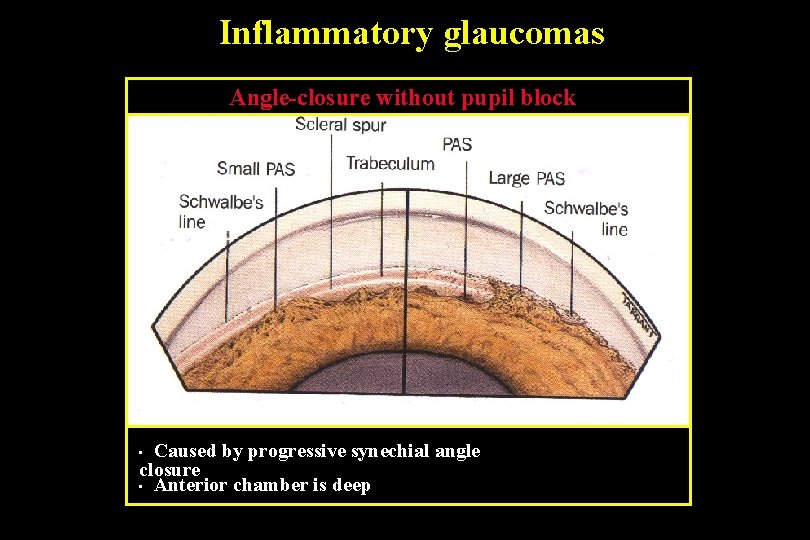 Inflammatory glaucomas Angle-closure without pupil block Caused by progressive synechial angle closure • Anterior