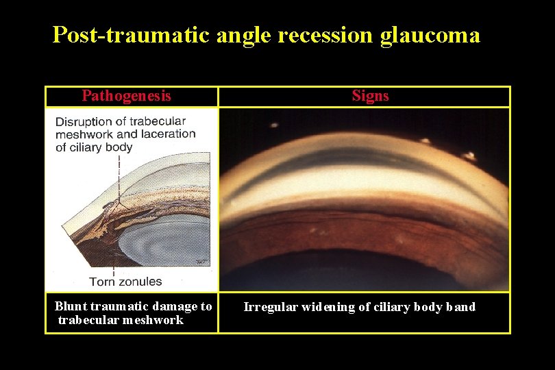 Post-traumatic angle recession glaucoma Pathogenesis Blunt traumatic damage to trabecular meshwork Signs Irregular widening