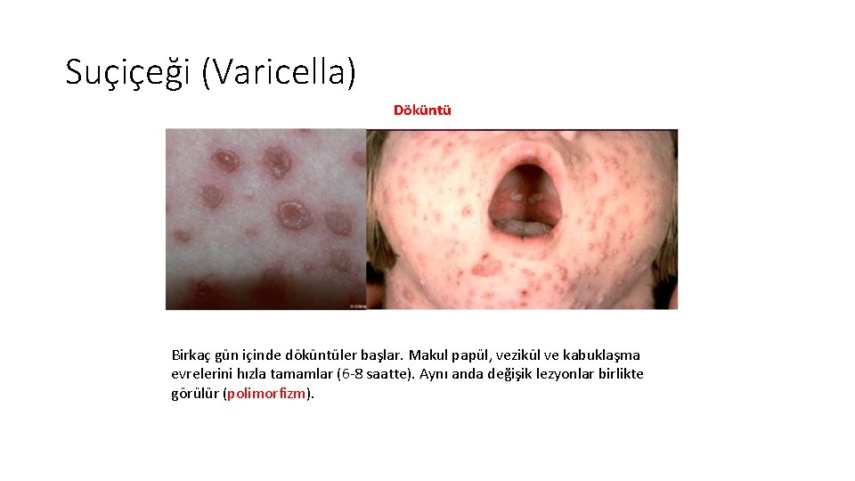 Suçiçeği (Varicella) Döküntü Birkaç gün içinde döküntüler başlar. Makul papül, vezikül ve kabuklaşma evrelerini