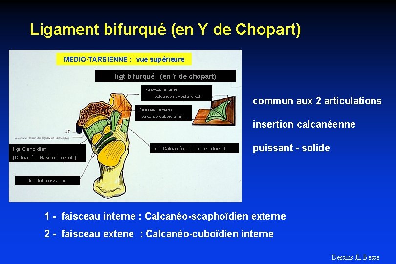 Ligament bifurqué (en Y de Chopart) MEDIO-TARSIENNE : vue supérieure ligt bifurqué (en Y