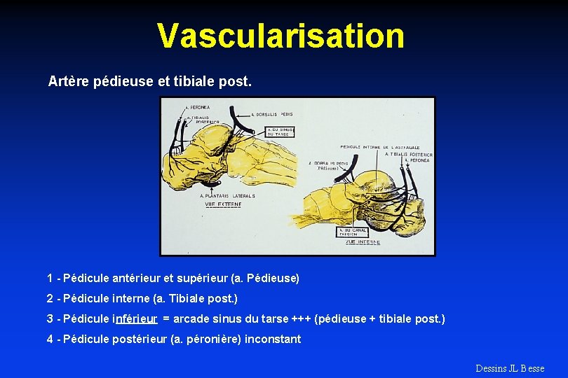 Vascularisation Artère pédieuse et tibiale post. 1 - Pédicule antérieur et supérieur (a. Pédieuse)