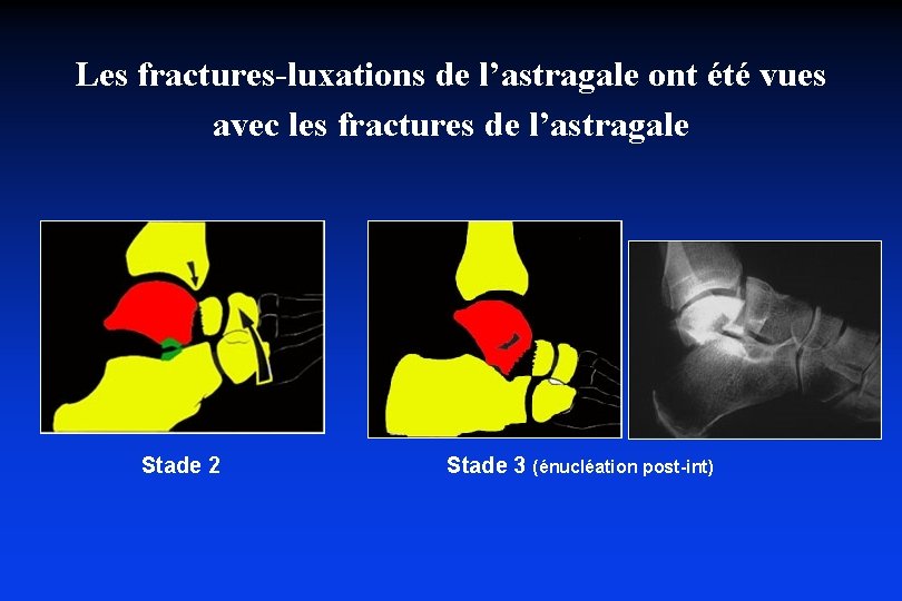 Les fractures-luxations de l’astragale ont été vues avec les fractures de l’astragale Stade 2