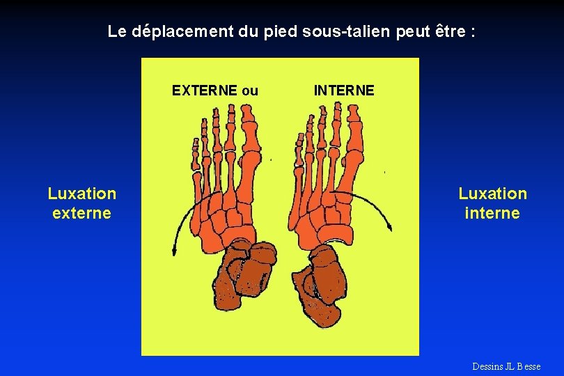 Le déplacement du pied sous-talien peut être : EXTERNE ou Luxation externe INTERNE Luxation