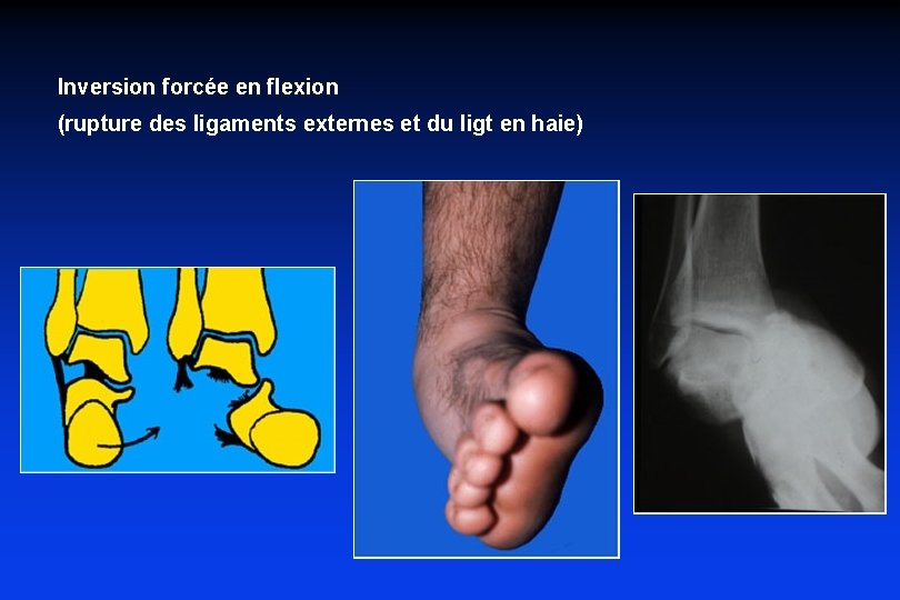 Inversion forcée en flexion (rupture des ligaments externes et du ligt en haie) 