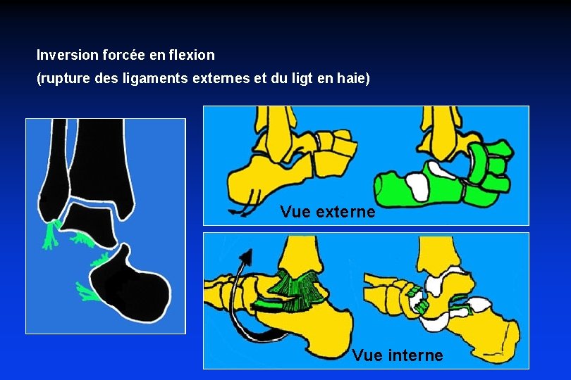 Inversion forcée en flexion (rupture des ligaments externes et du ligt en haie) Vue