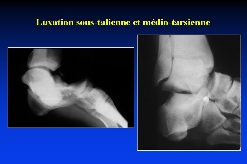 Luxation sous-talienne et médio-tarsienne 