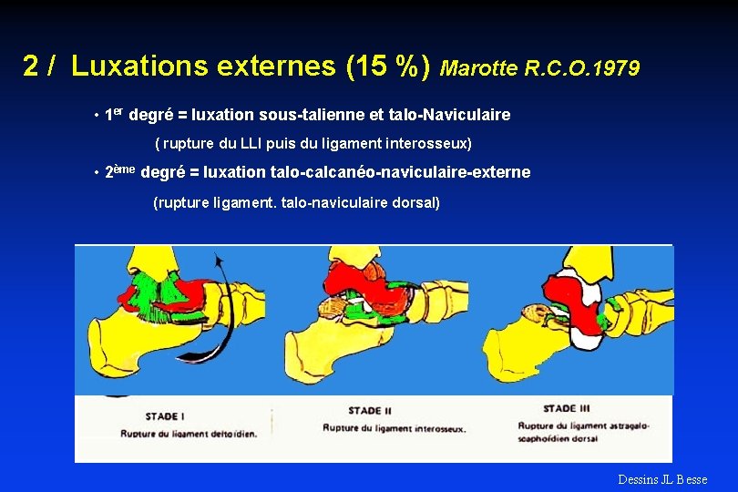 2 / Luxations externes (15 %) Marotte R. C. O. 1979 • 1 er