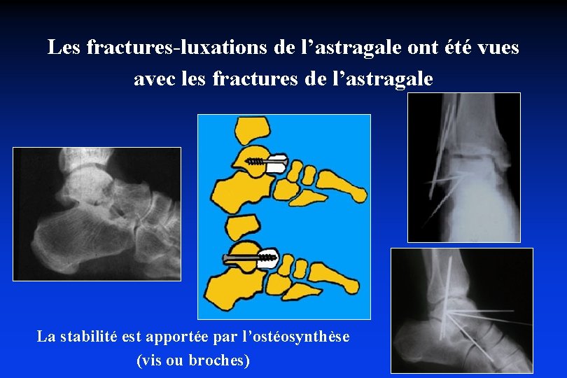 Les fractures-luxations de l’astragale ont été vues avec les fractures de l’astragale La stabilité