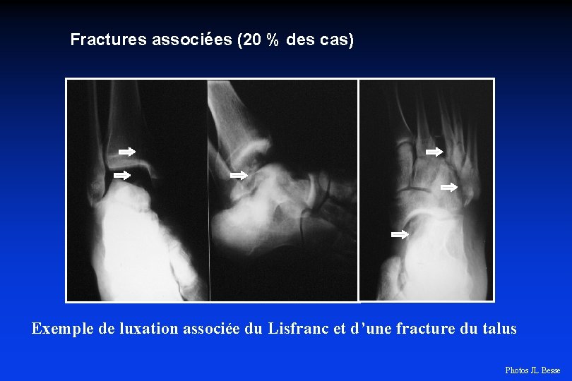 Fractures associées (20 % des cas) Exemple de luxation associée du Lisfranc et d’une
