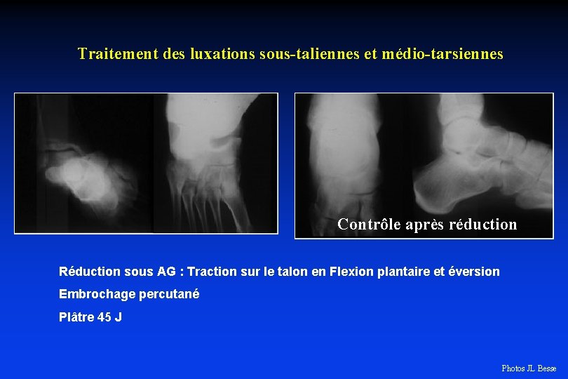 Traitement des luxations sous-taliennes et médio-tarsiennes Contrôle après réduction Réduction sous AG : Traction