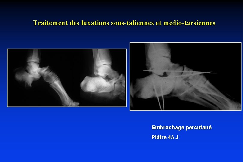 Traitement des luxations sous-taliennes et médio-tarsiennes Embrochage percutané Plâtre 45 J 