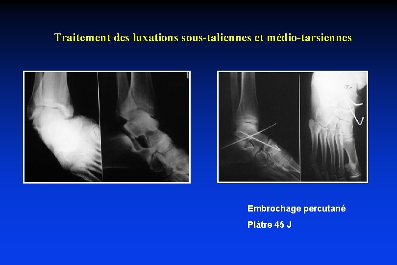 Traitement des luxations sous-taliennes et médio-tarsiennes Embrochage percutané Plâtre 45 J 
