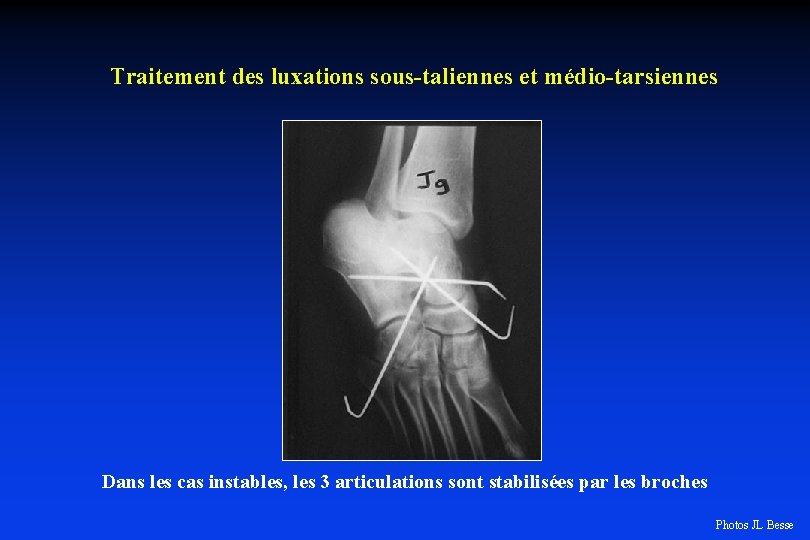 Traitement des luxations sous-taliennes et médio-tarsiennes Dans les cas instables, les 3 articulations sont
