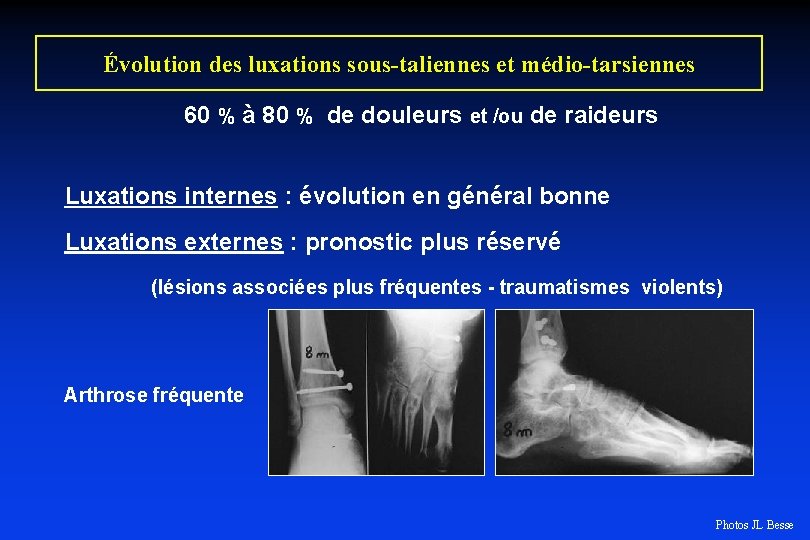 Évolution des luxations sous-taliennes et médio-tarsiennes 60 % à 80 % de douleurs et
