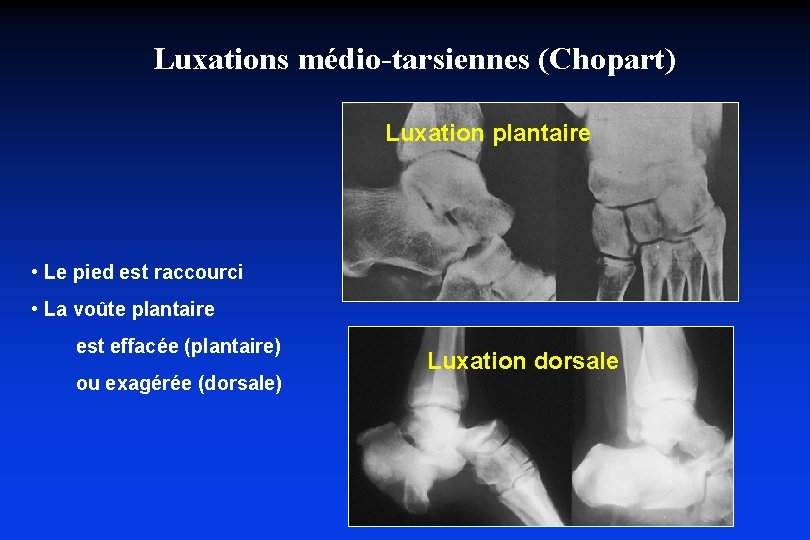 Luxations médio-tarsiennes (Chopart) Luxation plantaire • Le pied est raccourci • La voûte plantaire