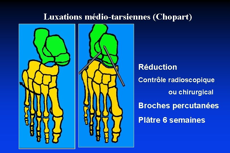 Luxations médio-tarsiennes (Chopart) Réduction Contrôle radioscopique ou chirurgical Broches percutanées Plâtre 6 semaines 
