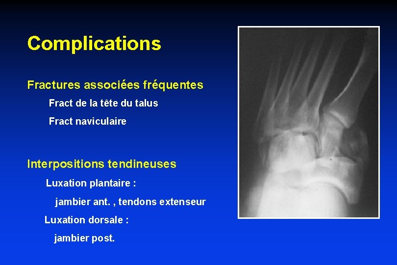 Complications Fractures associées fréquentes Fract de la tête du talus Fract naviculaire Interpositions tendineuses