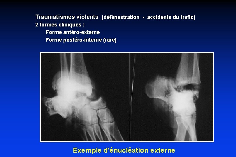 Traumatismes violents (défénestration - accidents du trafic) 2 formes cliniques : Forme antéro-externe Forme
