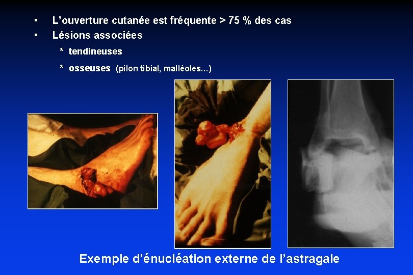  • • L’ouverture cutanée est fréquente > 75 % des cas Lésions associées