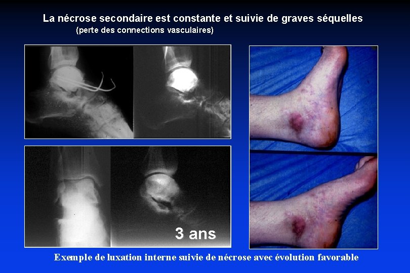 La nécrose secondaire est constante et suivie de graves séquelles (perte des connections vasculaires)