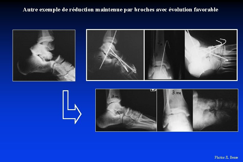 Autre exemple de réduction maintenue par broches avec évolution favorable Photos JL Besse 