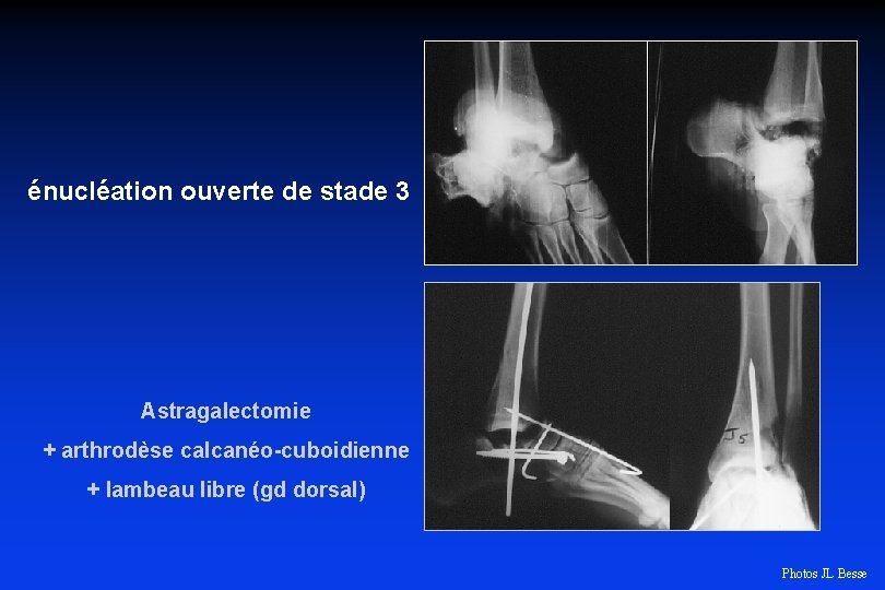 énucléation ouverte de stade 3 Astragalectomie + arthrodèse calcanéo-cuboidienne + lambeau libre (gd dorsal)