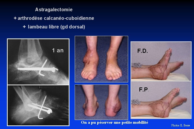 Astragalectomie + arthrodèse calcanéo-cuboidienne + lambeau libre (gd dorsal) 1 an F. D. F.