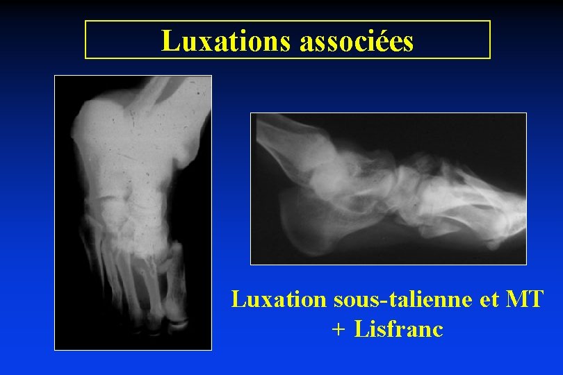 Luxations associées Luxation sous-talienne et MT + Lisfranc 