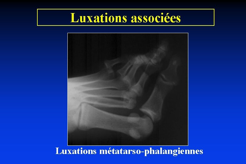Luxations associées Luxations métatarso-phalangiennes 