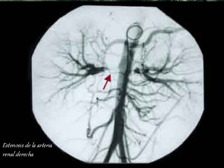 Estenosis de la arteria renal derecha 