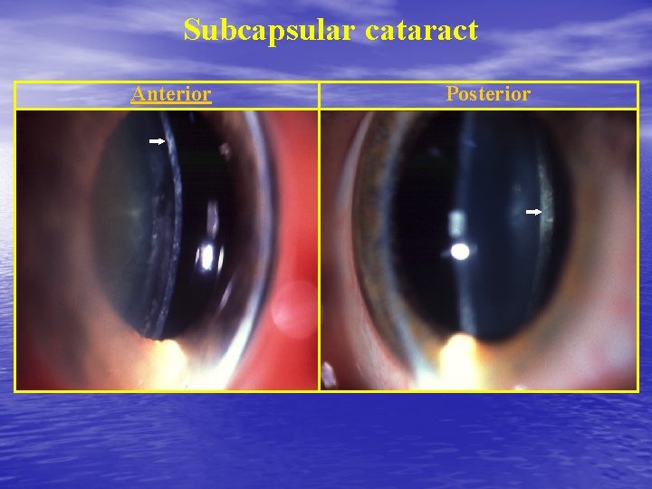 Subcapsular cataract Anterior Posterior 