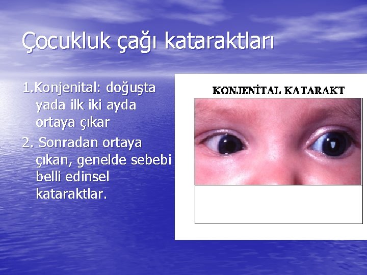 Çocukluk çağı kataraktları 1. Konjenital: doğuşta yada ilk iki ayda ortaya çıkar 2. Sonradan