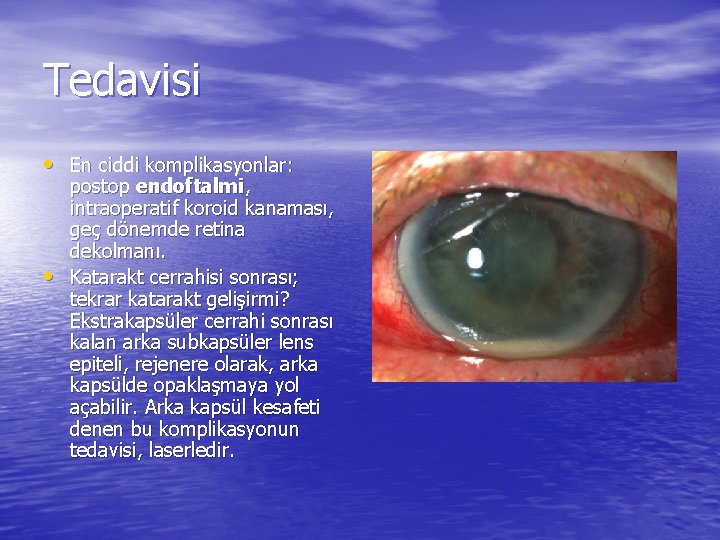 Tedavisi • En ciddi komplikasyonlar: • postop endoftalmi, intraoperatif koroid kanaması, geç dönemde retina