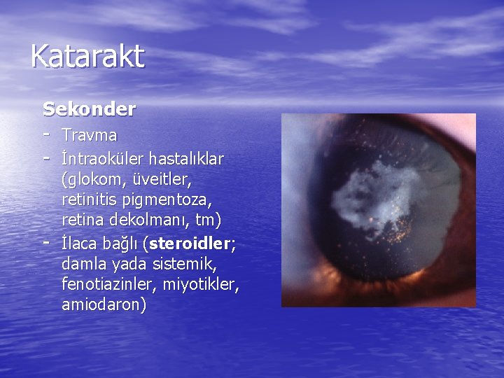 Katarakt Sekonder - Travma - İntraoküler hastalıklar - (glokom, üveitler, retinitis pigmentoza, retina dekolmanı,